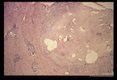 Gross and microscopic photos of human liver from Minnesota where about one half of the red foxes are infected.