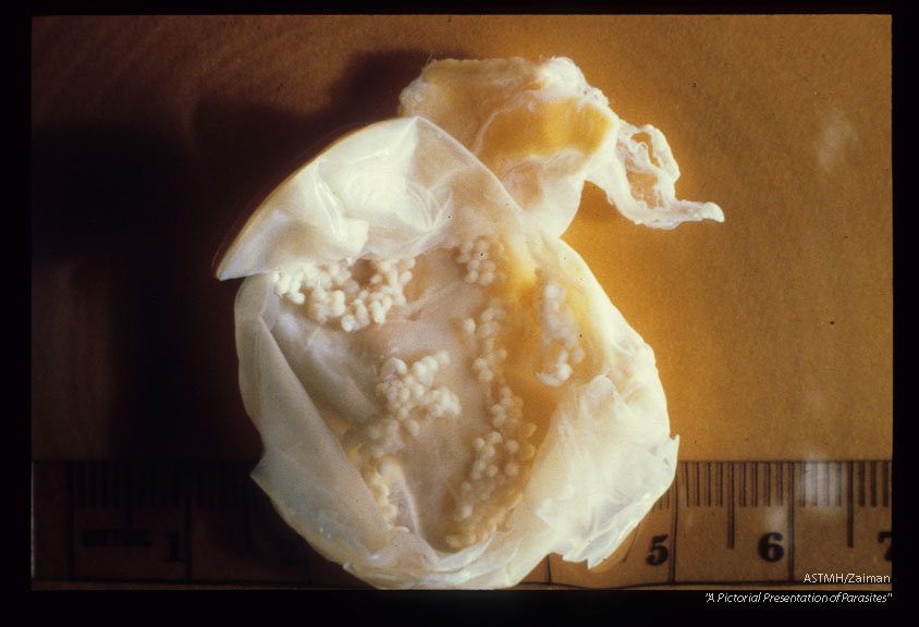 Opened cysts showing multiple protoscolices.
