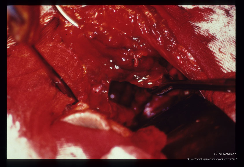 A 26 year old Italian male presented with jaundice due to biliary tree obstructions by daughter cysts of Echinoccocus granulosus. Picture sequence of operative dissection. Removal of cysts, placement of multiple drains and creation of several anastomoses were required to ensure proper biliary drainage and to prevent bile peritonitis.