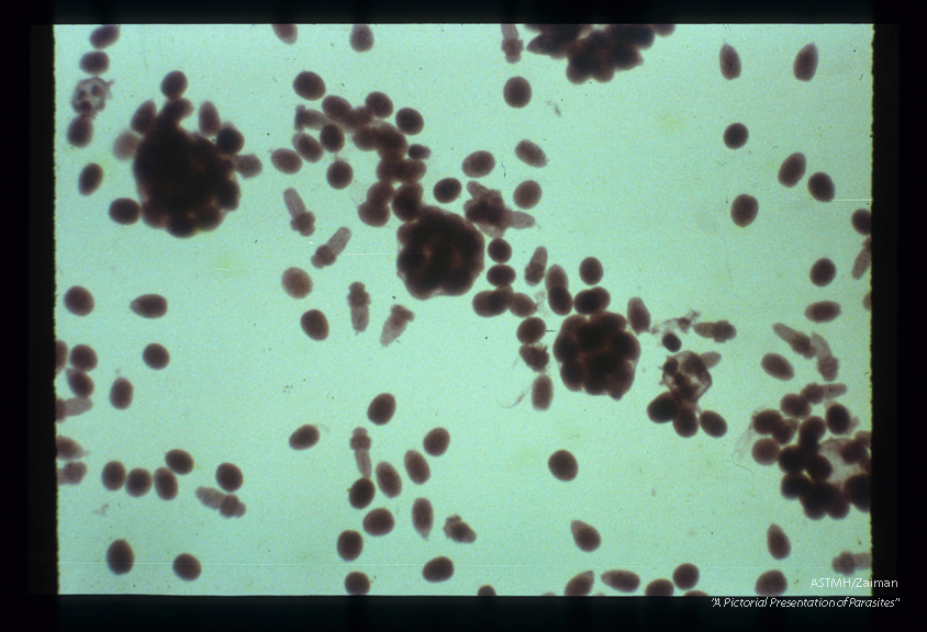 Hydatid sand. Numerous scolice some free, some in cysts accumulated at the low points of an hydatid cyst. When the free scolices evert, the suckers may protrude to give a cross-like appearance.