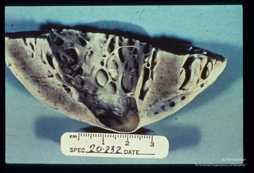 Multiple specimens showing aneurysmal dilatation and thinning of the apical myocardium, plus marked concentric muscular hypertrophy.