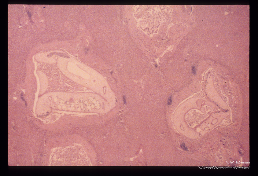 Liver. The parasites are seen in the biliary passages where they have caused considerable fibrosis. The parasite at the right is sectioned through the anterior sucker.