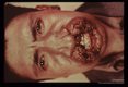 (South America). Three year old infection with involvement of naso-labial structures.