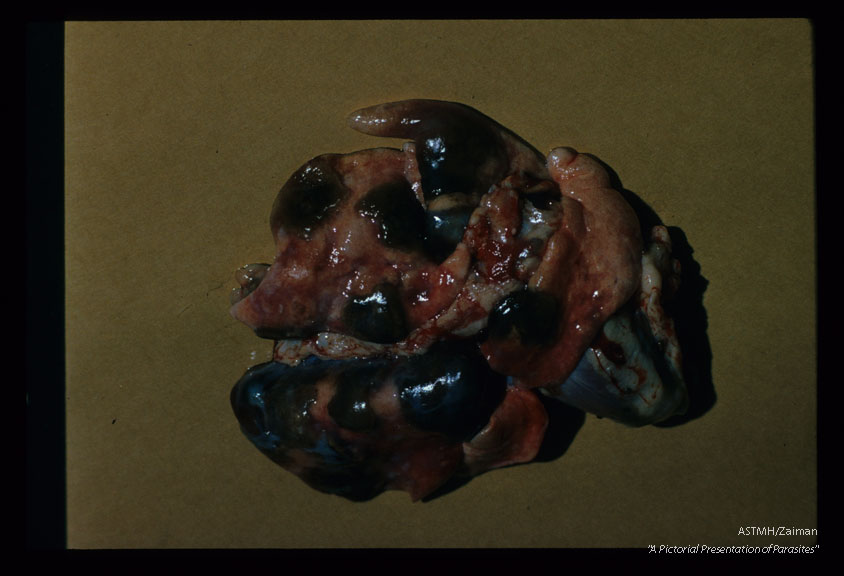 Mature experimental pulmonary infection in a cat showing extensive hemorrhage in and around cysts containing many Paragonimus.