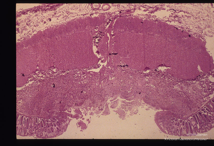 Sections through intestinal ulcers.