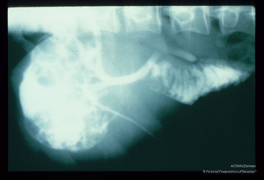 Contrast which appears white on x-ray was injected into the biliary tree of a patient who had a large cyst in the right lobe of the liver. The white contrast fills most of the cyst and the biliary tree proving a connection between the cyst and the bile ducts.