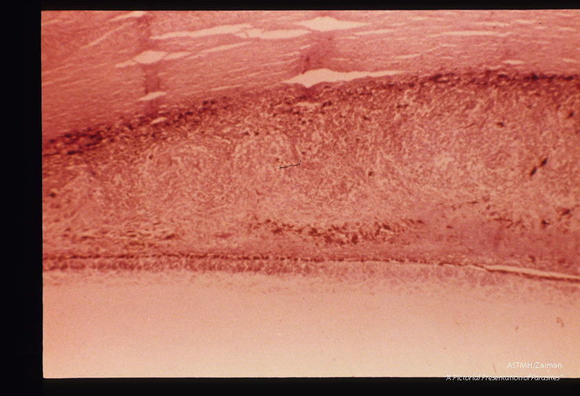 Toxoplasmic retinochoroiditis is associated with tachyzoites. Granulomatous reaction is present in choroid.