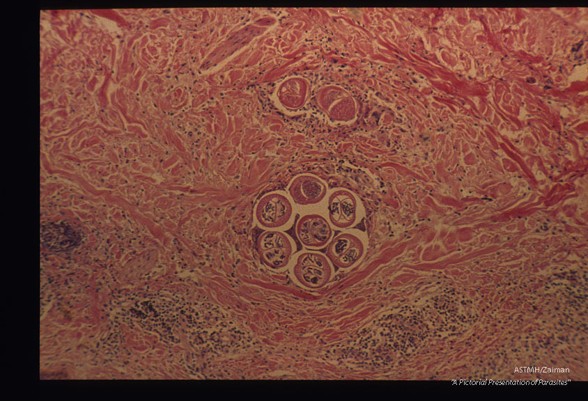 Section of skin with worms. H & E. Low and high magnifications.