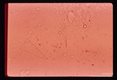 Free hooklets in renal cyst sand.