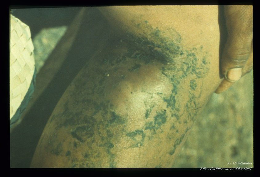 Abscess formation.