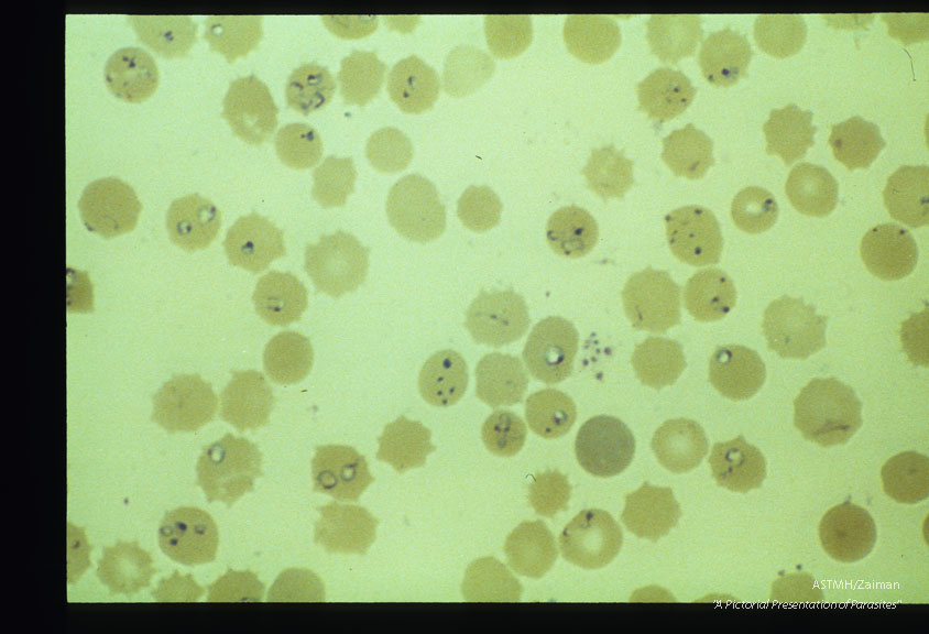 Giemsa stained slides from a fatal case on Fire Island, N. Y., (1982). The parasitemia is high for human babesiosis. Budding, multiply-infected erythrocytes, tetrad formation, band forms, reticulocytosis and clumping of extracellular parasites may be seen.