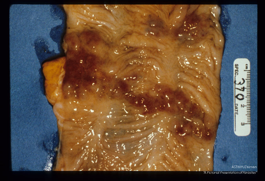 Clustered, patchy, early egg lesions in colonic mucosa of a chimpanzee.