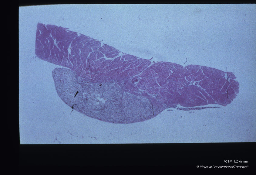 Huge deposits of Paragonimus eggs are engulfed in a granulomatis reaction on the surface of a dog diaphragm.