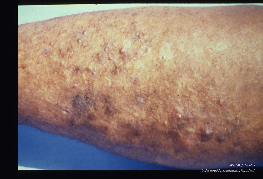 Folliculitis, hyperkeratosis and elephantiasis of the right leg of a fifty-four year old female. Case was acquired twenty-four years ago.