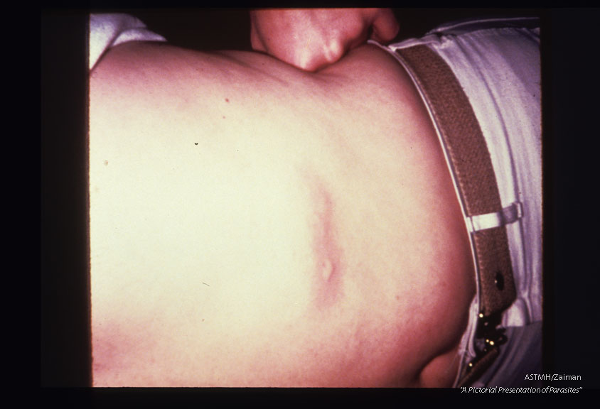 Linear, migrating, urticarial, pruritic rash on abdomen of patient suffering chronic infection.