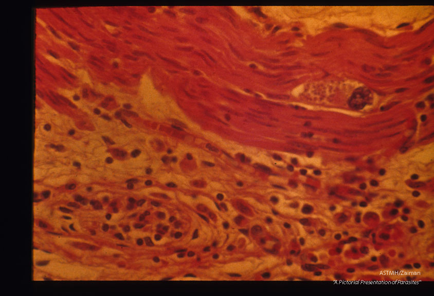 Congenital esophageal infection showing a parasitized giant cell.