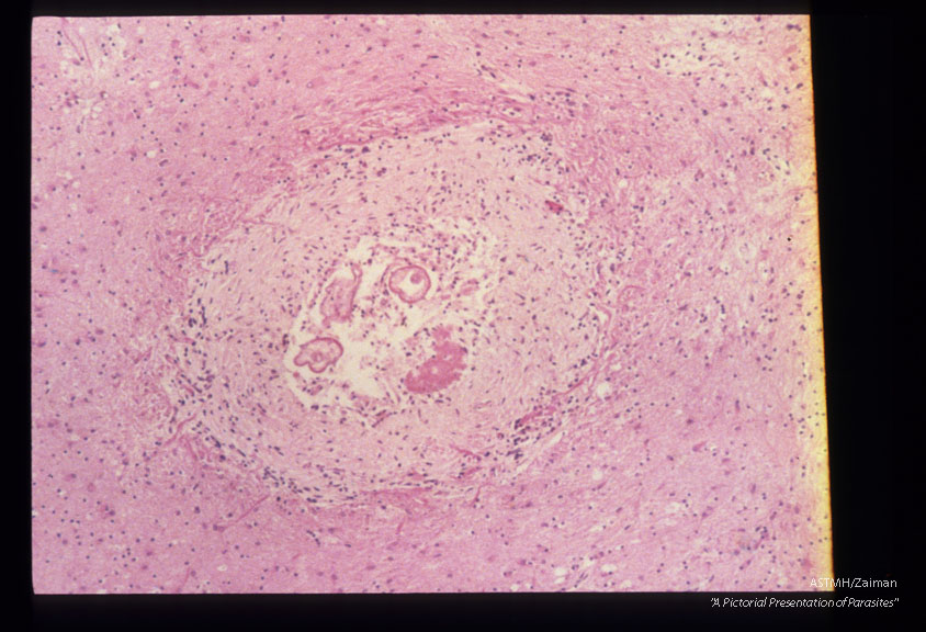 A two year old boy died following 14 months of CNS problems. CNS atrophy, sclerosis, gliosis and a larval granuloma in cerebrum are shown.