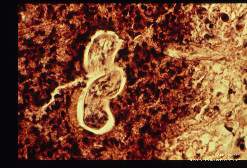 Sections through larvae in retinal granulomas (human case).