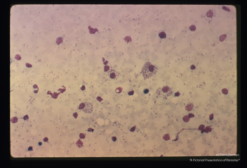 Low power view of touch preparation made from experimentally infected hamster spleen. Several macrophages contain numerous parasites. Other parasites appear free in the fluid portion of the preparation.