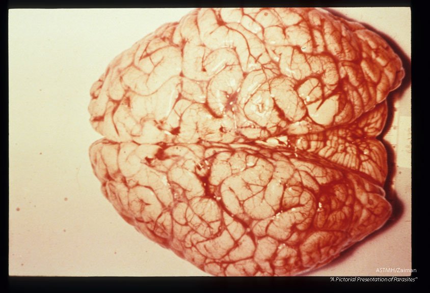 Edematous brain showing narrowed sulci and flattened gyri, more pronounced on the right.