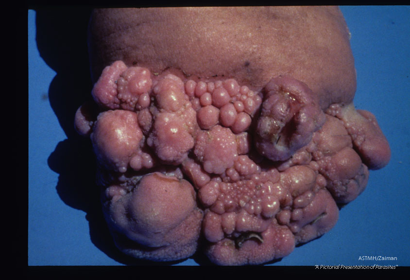 Advanced papillomatous changes on the left toes of a forty year old female. The case was acquired twenty-four years ago. The leg is enlarged but with little other skin change.