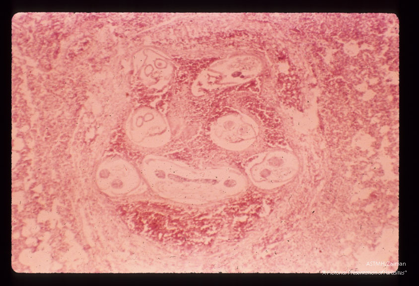 Nematode in human brain.