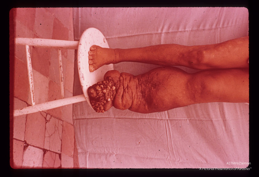 Elephantiasis of lower extremities.