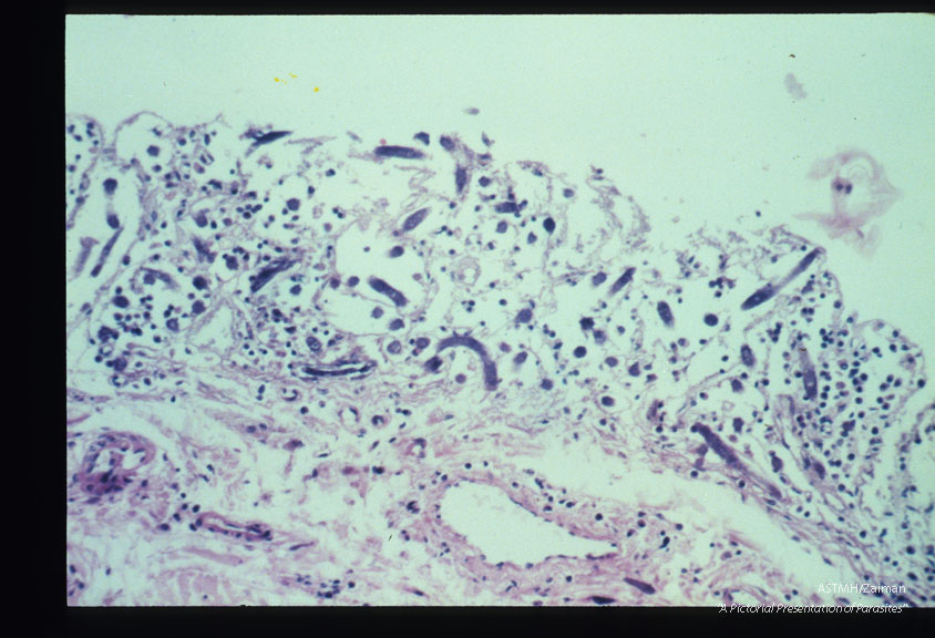 Hyperinfection in the colon of an immunosuppressed patient.