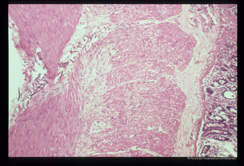 Larval migration through colonic wall during experimental infection of Erythrocebus pata.