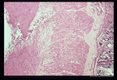 Larval migration through colonic wall during experimental infection of Erythrocebus pata.