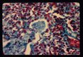 Pneumonia. Higher magnification of infected lung stained by Wheatly modification of trichrome stain for stools showing 