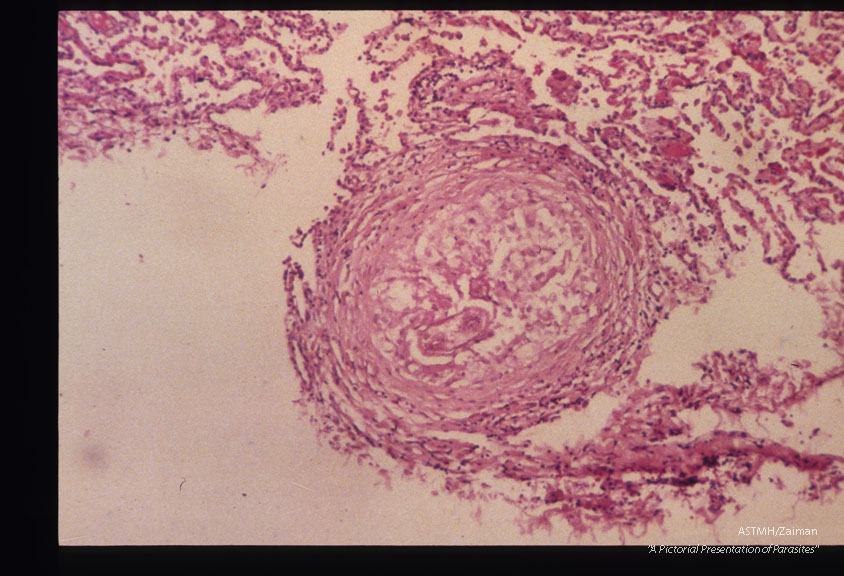 Same case. Pulmonary granulomas with larvae.