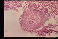 Same case. Pulmonary granulomas with larvae.