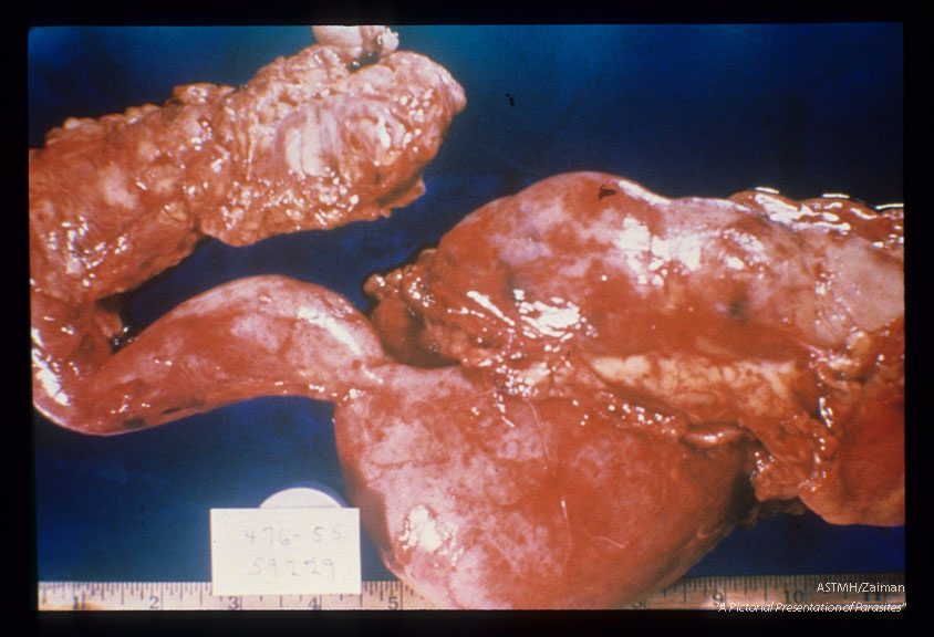 Hydroureter and hydronephrosis, fresh and formalin fixed specimens.