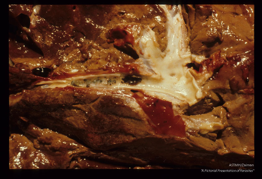 Calcareous flakes in bovine bile ducts.