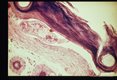 Cercariae before and after skin penetration. These slides compliment slides 1258 through 1262.