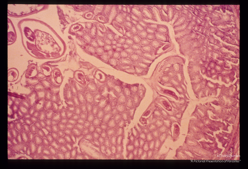 Dog cecum. The thin anterior portion is seen in the mucosa. The cross section in the lumen at the left upper corner has a larger diameter, and is of course from the posterior "handle". Eggs are present in the uterus of this worm.