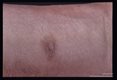 Healing skin lesion.