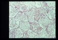 Pneumonia. The characteristic foamy alveolar exudate is well seen.