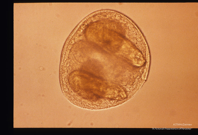 Metacercaria which may cause pleuritis and pneumothorax in man.