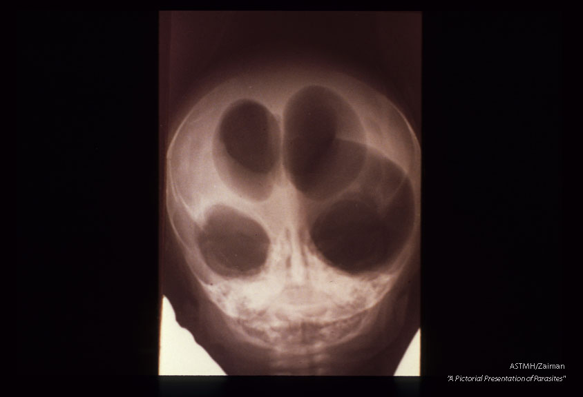 Encephalitis with hydrocephalus. Ventriculogram shows marked dilatation of ventricles.