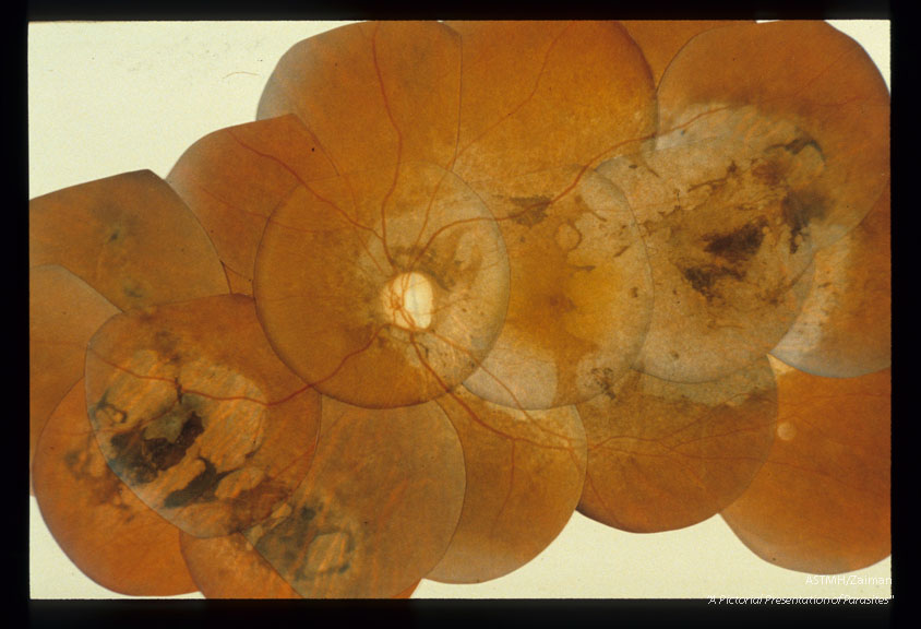 Photographic montage of a 23 year old Ghanian male showing extensive choreoretinal atrophy and optic atrophy.