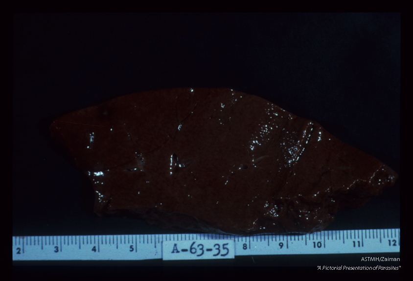 Human liver with a single visible pseudotubercle surrounded by hemorrhage.