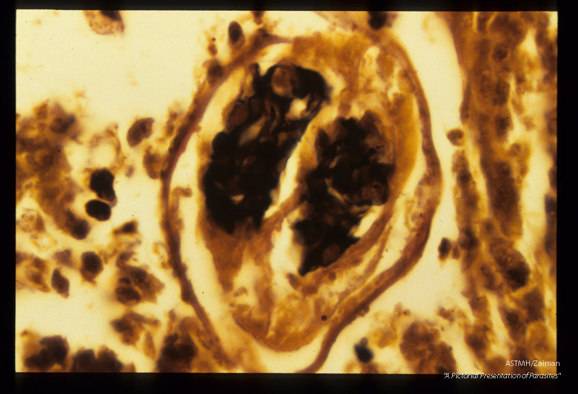 Adolescent filaria in pulmonary artery. Ipw and high power view. Elastic Berhoeff stain.