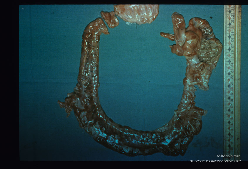 Autopsy specimen of large bowel.