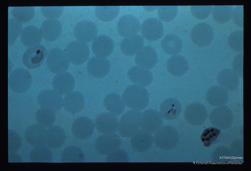 Schizont with at least seven nuclear masses and two earlier stages in other erythrocytes.