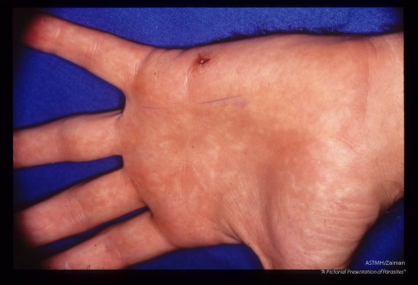 Gross views of hand with inplanted nematode in preexisting puncture wound.