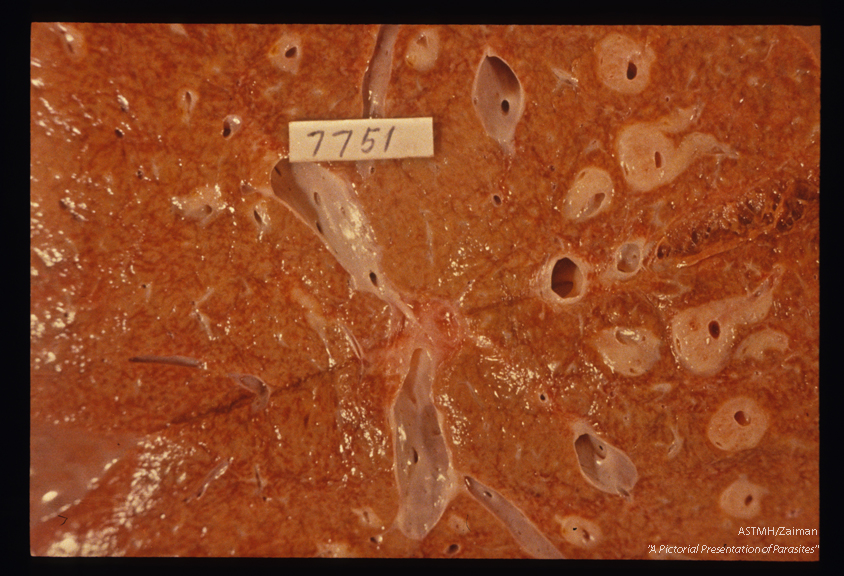 Human liver showing typical "pipestem fibrosis" due to embolization of eggs from the mesenteric vessels.