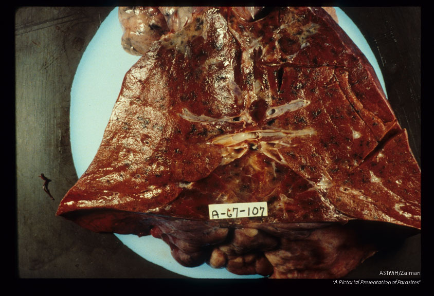 Gross lung specimen showing brick red colored pneumonia.