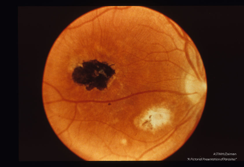 Healed retinal toxoplasmic lesion.